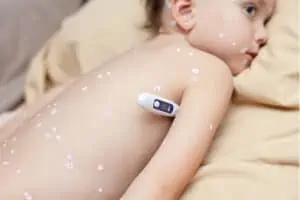Ako sa prejavujú ovčie kiahne a ako ich liečiť
