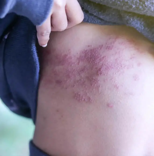 herpes zoster