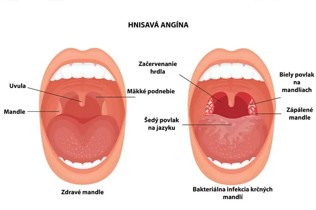 hnisava angina