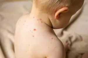 co pomaha na ovcie kiahne