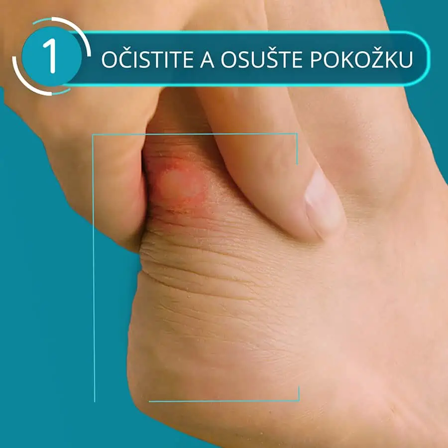 Compeed náplasť na pľuzgiere stredná - krok 1