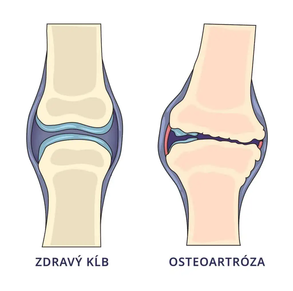 porovnanie zdravého kĺbu a osteoartrózy