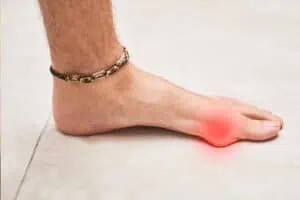 hallux valgus